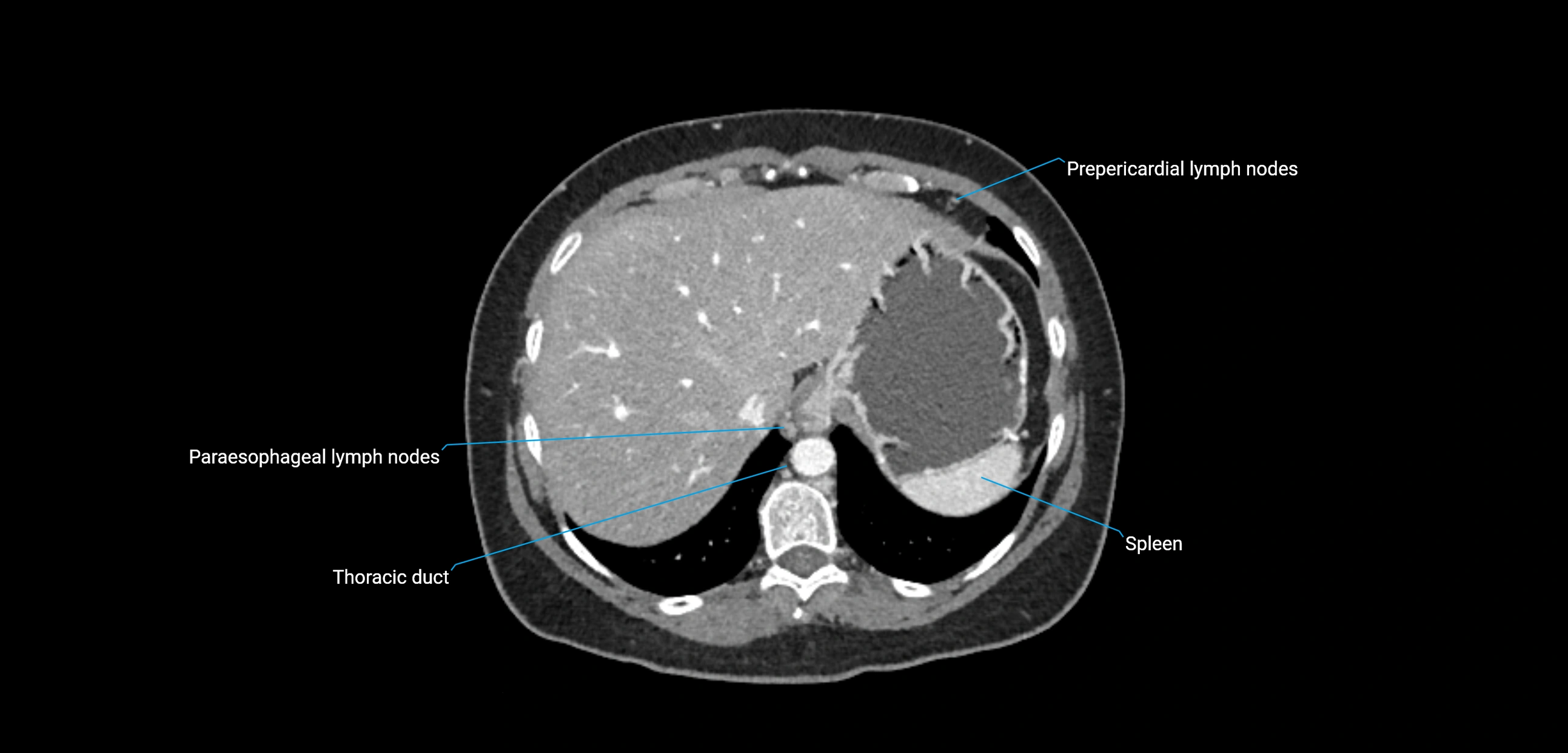CT ct abdominal lymph nodes  axial cross sectional anatomy  enchanced radiology image -img-00002-00090.webp